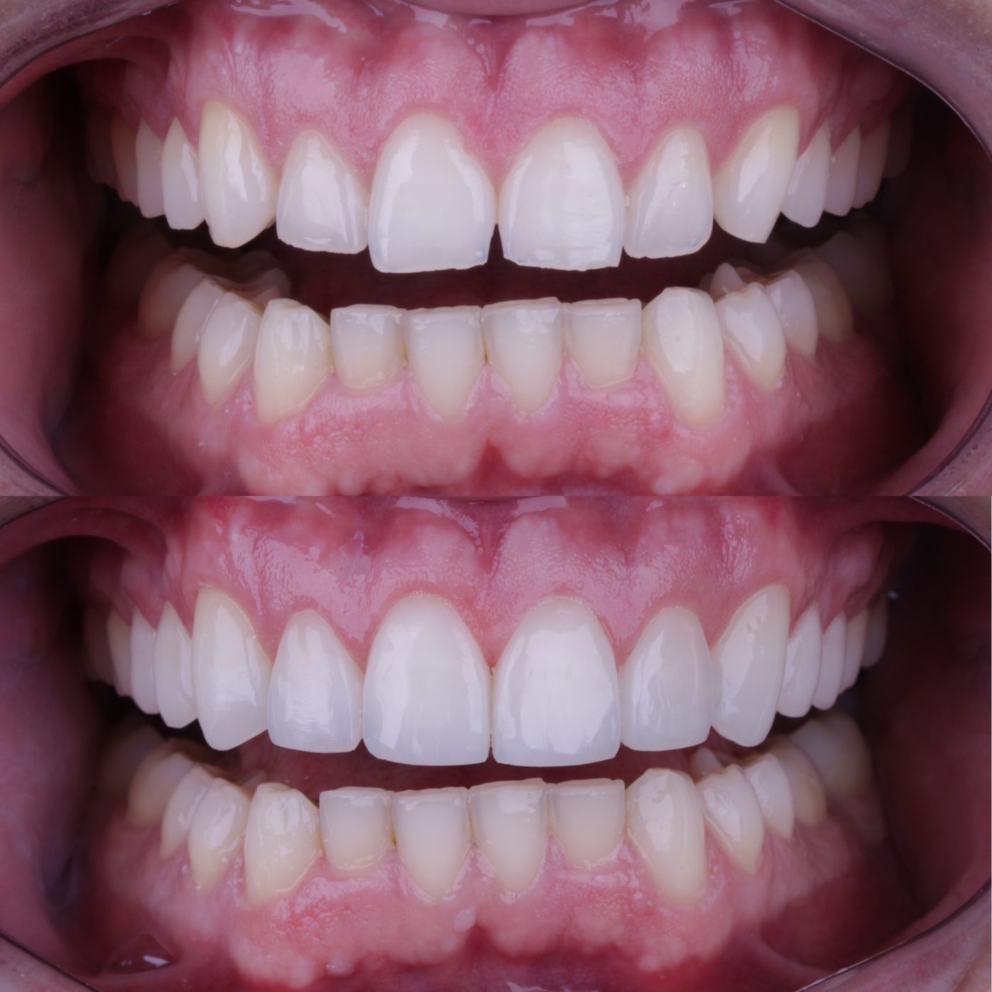 Antes e depois de acréscimo de resina