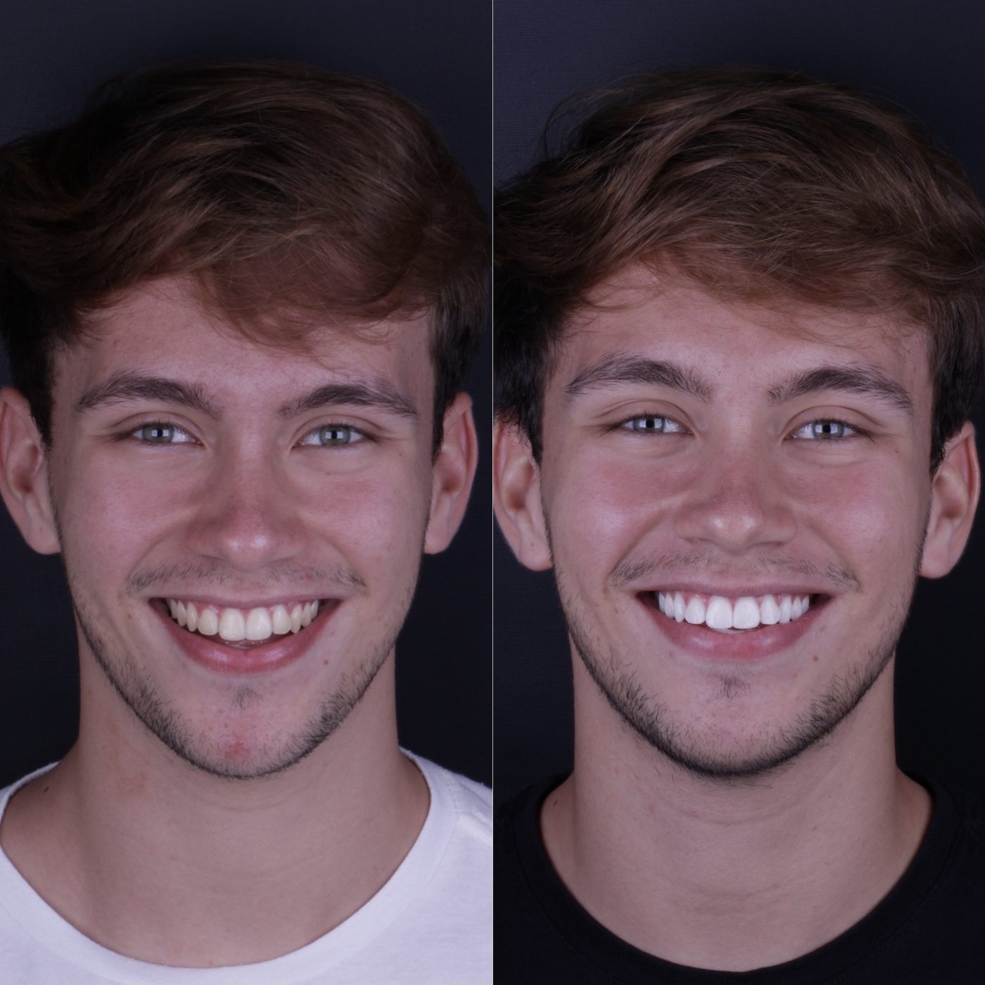 Antes e depois de clareamento dental