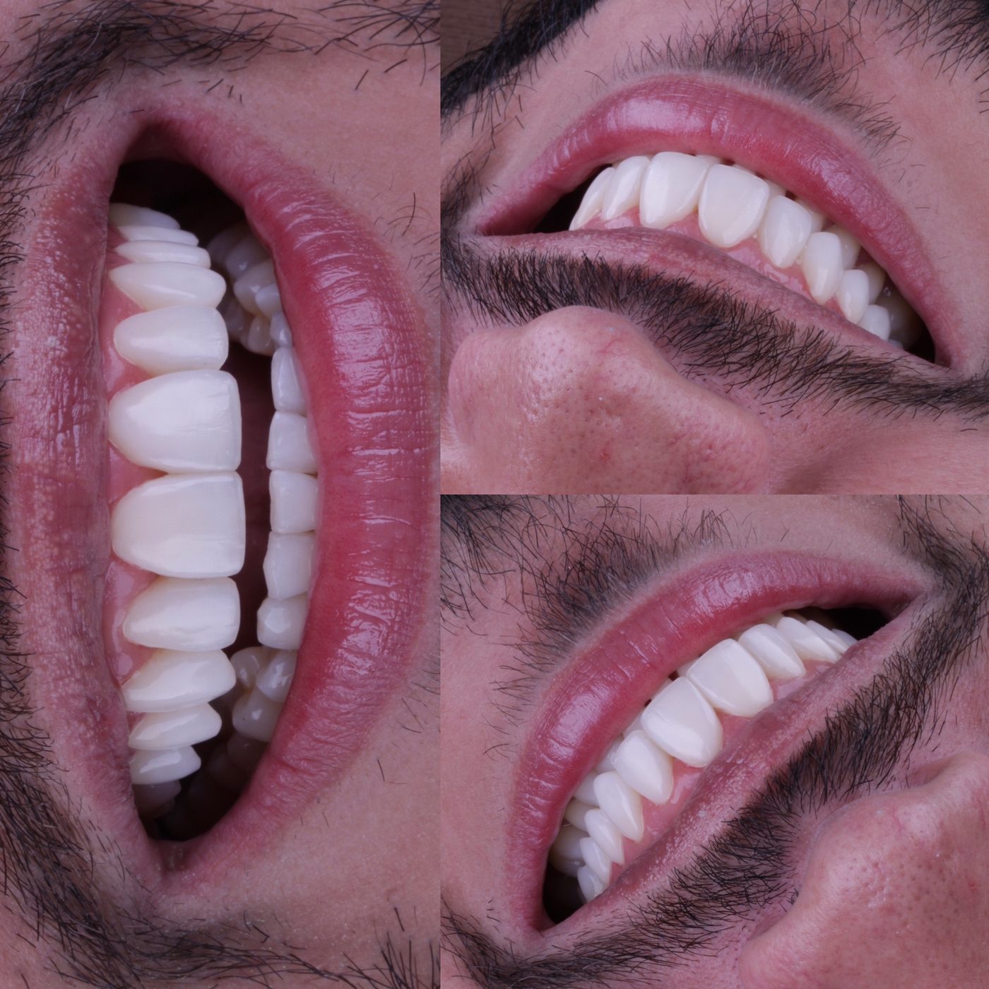 Facetas em resina em três ângulos