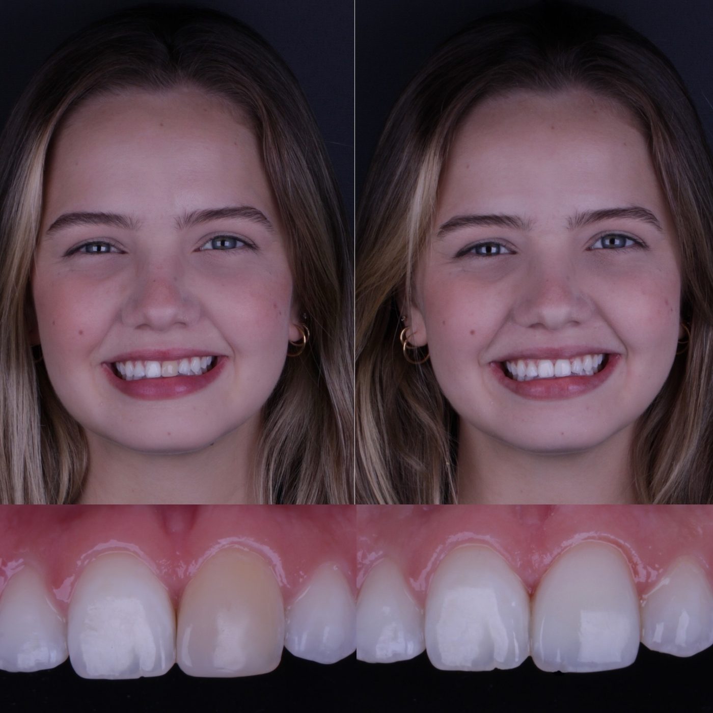 Antes e depois de facetas em resina