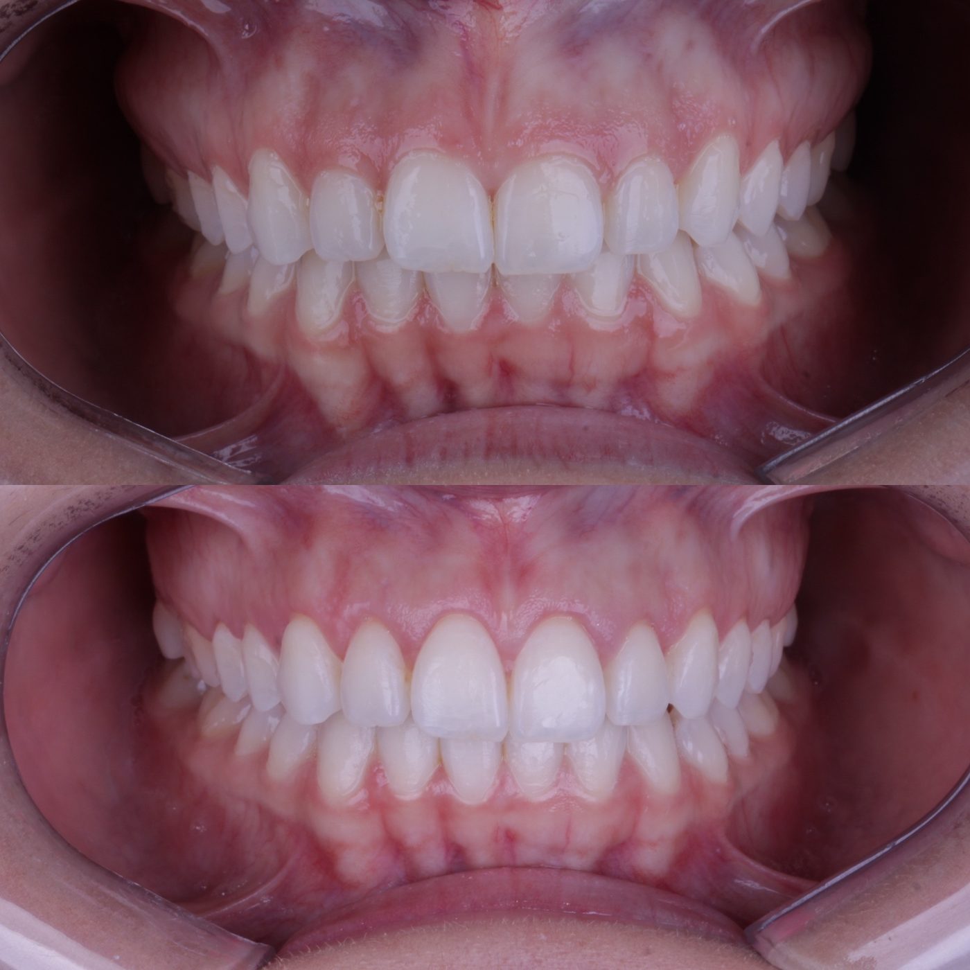 Antes e depois de gengivoplastia