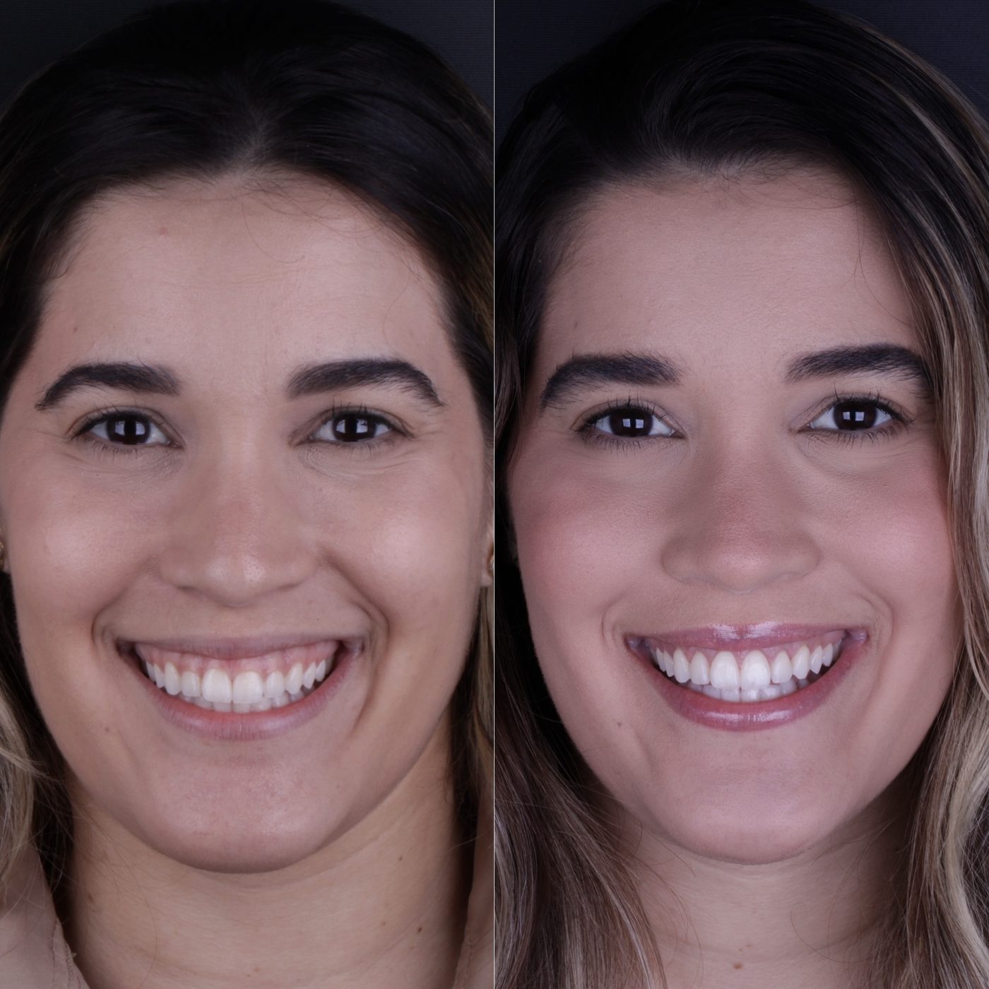 Antes e depois de gengivoplastia
