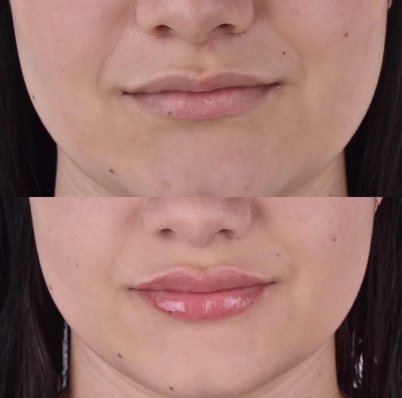 Antes e depois de preenchimento labial