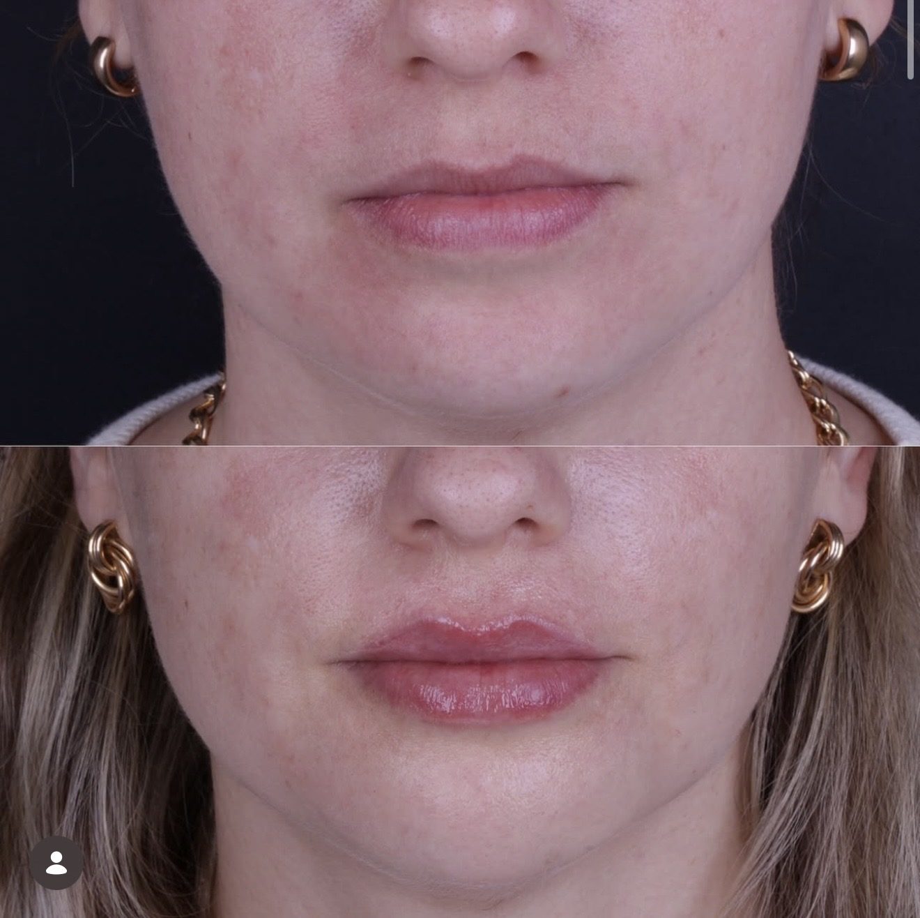 Antes e depois de preenchimento labial