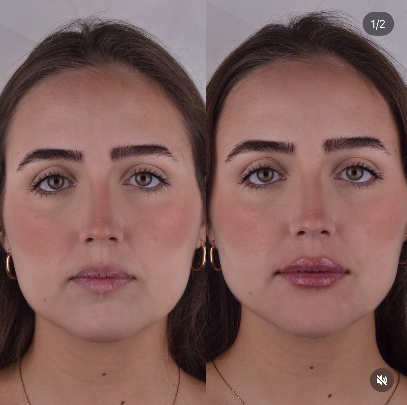 Antes e depois de preenchimento labial